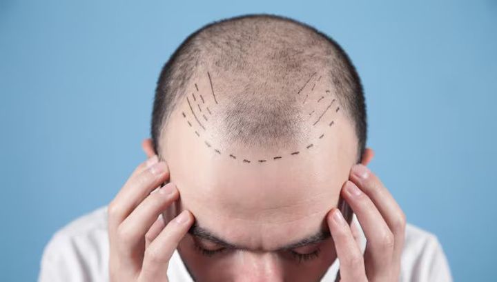 Hair Transplant Explore: Techniques, Procedure Process, Recovery and Important Factors