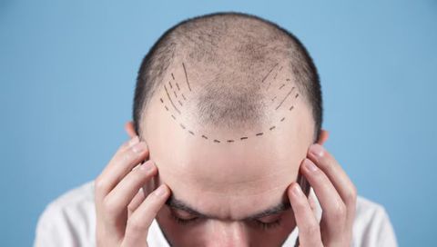 Hair Transplant Explore: Techniques, Procedure Process, Recovery and Important Factors
